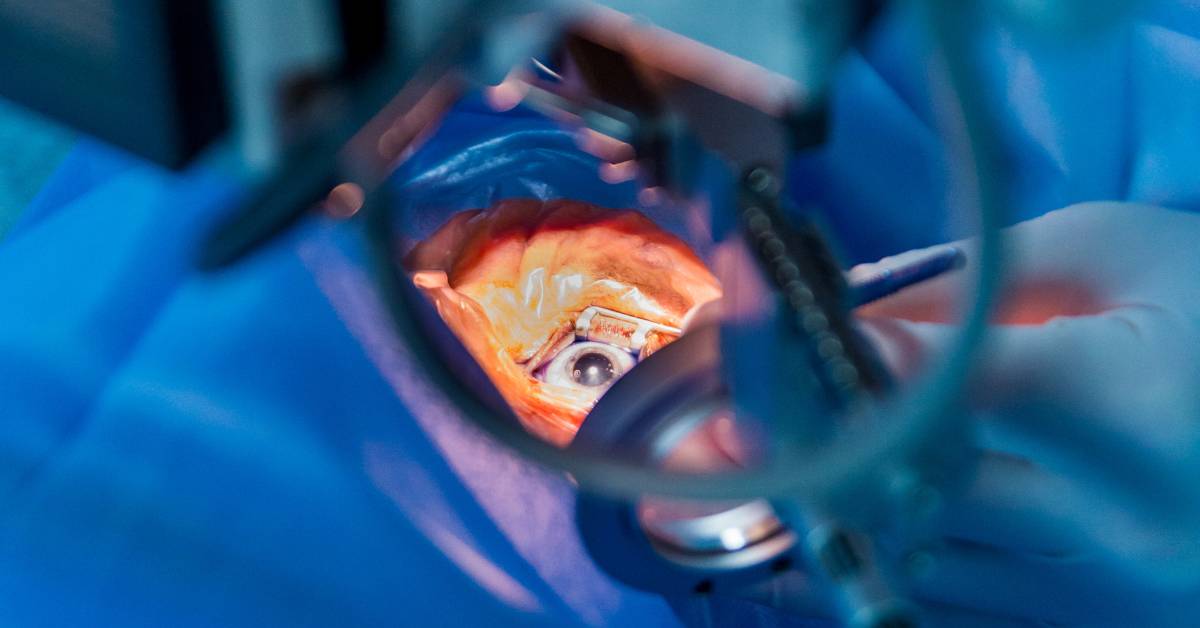 Operace šedého zákalu: Co je to, jak probíhá a kdy je potřeba? 1 a close-up of cataract surgery showing clouded natural eye lens removal with surgical tools under sterile drapes