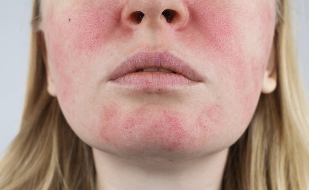 a person’s face showing facial skin redness and inflammation typical of rosacea with visible dilated blood vessels on the nose and cheeks