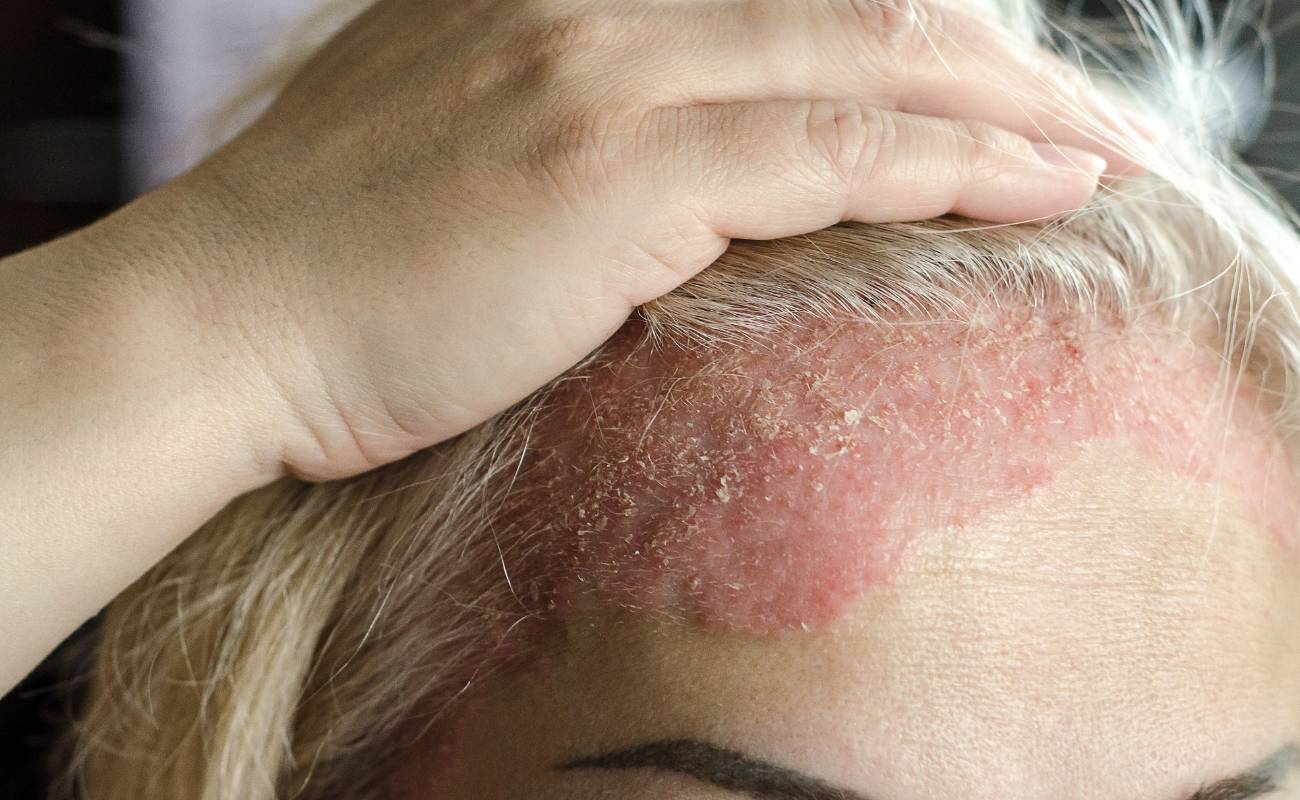 Babské rady na lupénku: 15 Nejlepších tipů pro zvládnutí této kožní nemoci 1 a person’s scalp with visible red, scaly psoriasis plaques being gently touched by a hand, illustrating skin irritation and zánět kůže.