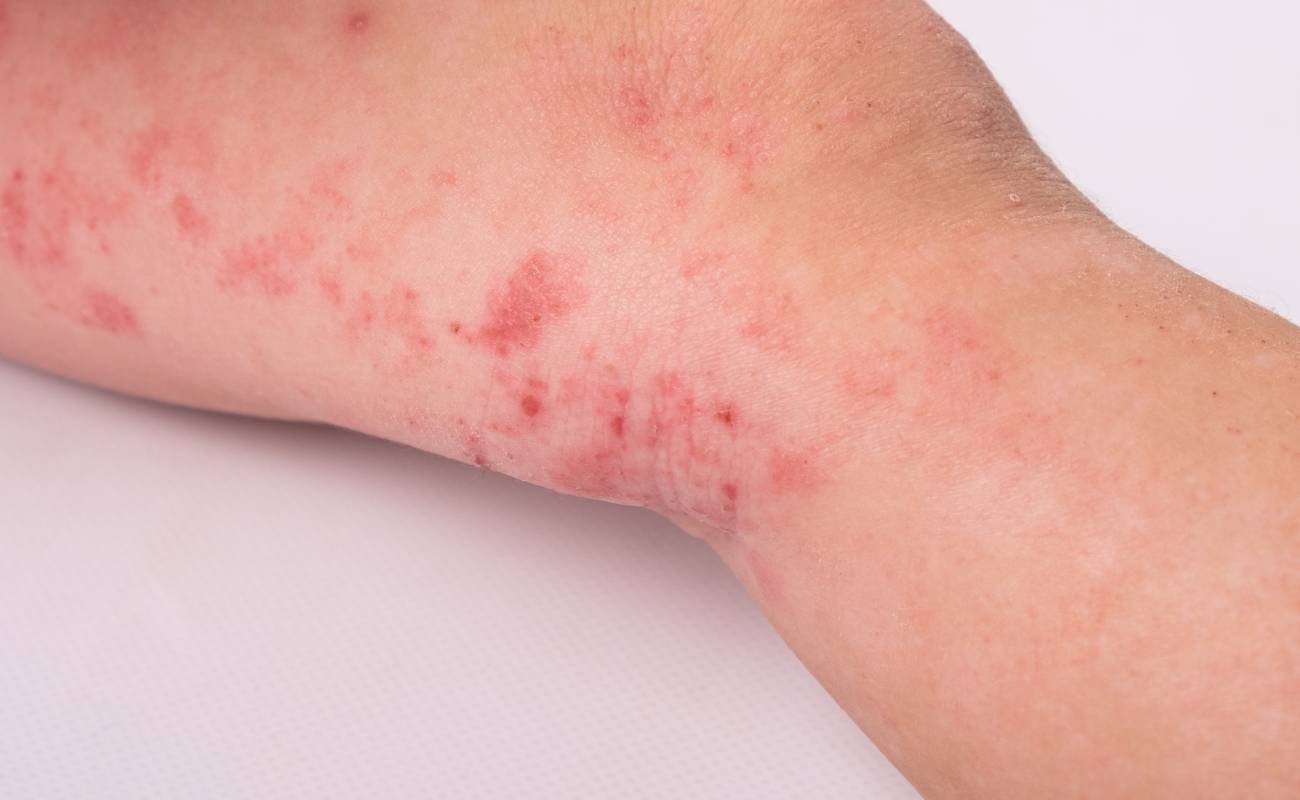 Co Na Opruzeniny: 8 Babských Rad, Které Skutečně Pomáhají 1 a close-up of red, irritated skin showing signs of kožní podráždění and zarudnutí pokožky on an elbow.