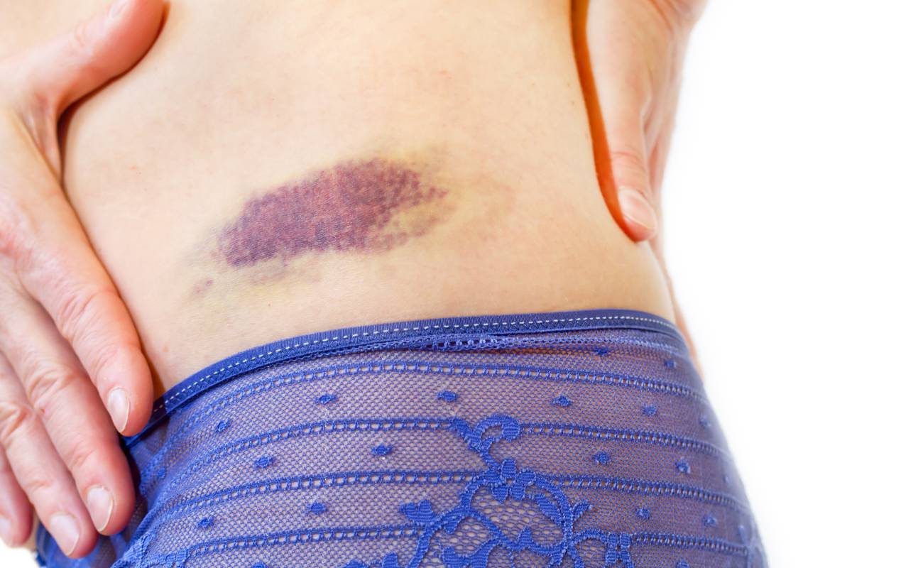 Víme co chybí tělu když se dělají modřiny & Co pomáhá! 1 a person’s arm showing a large bruise with varying shades of purple, red, and yellow indicating subcutaneous bleeding and tissue damage.