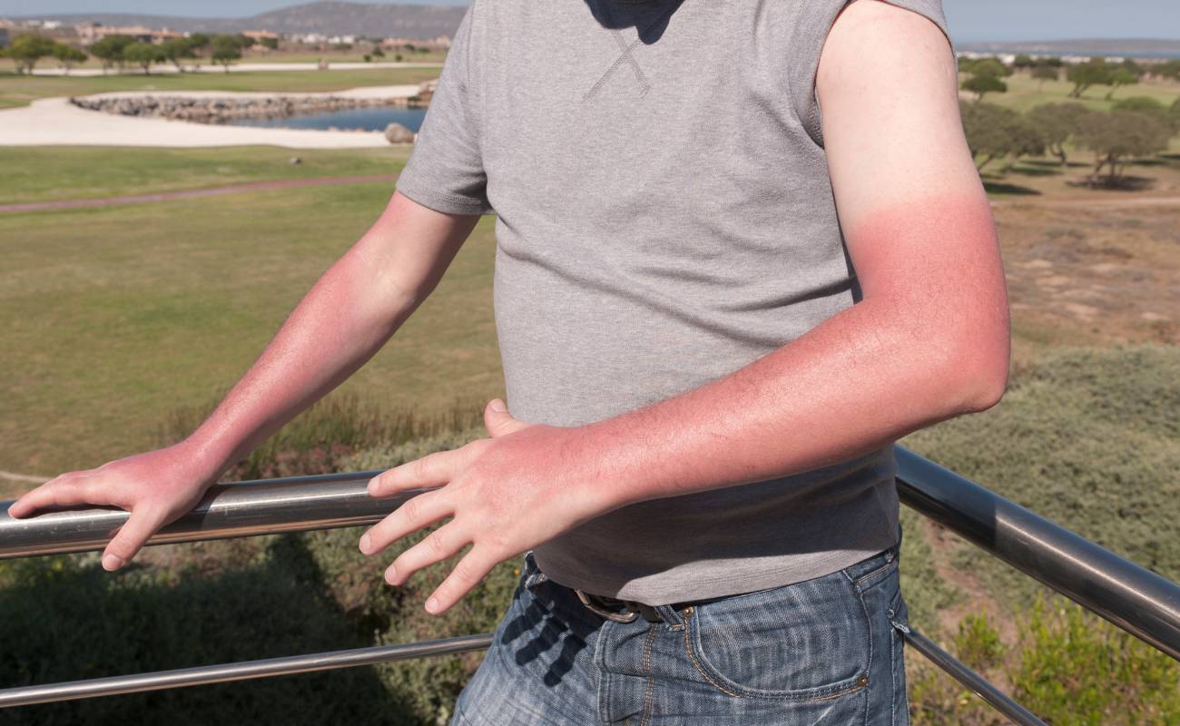 13 Nejlepších Babských Rad na Spálení od Slunce, Které Opravdu Fungují 1 a person leaning on a railing with visible sun-exposed, reddened arms suggesting mild sunburn.